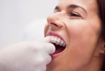 Invisalign las vegas