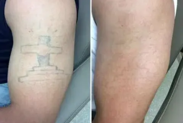 skin tag removal device